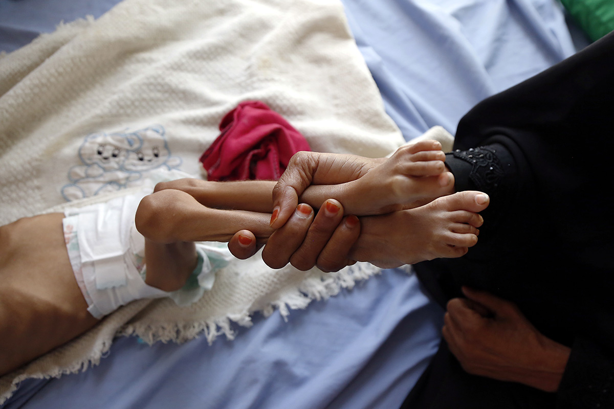 Гражданская война в Йемене продолжается три года. Повстанцы хуситы, поддерживаемые Ираном, захватили большую часть страны, включая столицу Сану. В 2015 году к войне присоединились Саудовская Аравия и ее союзники, среди которых Объединенные Арабские Эмираты (ОАЭ). На фото: ребенок на осмотре в больнице в йеменской провинции Хадджа