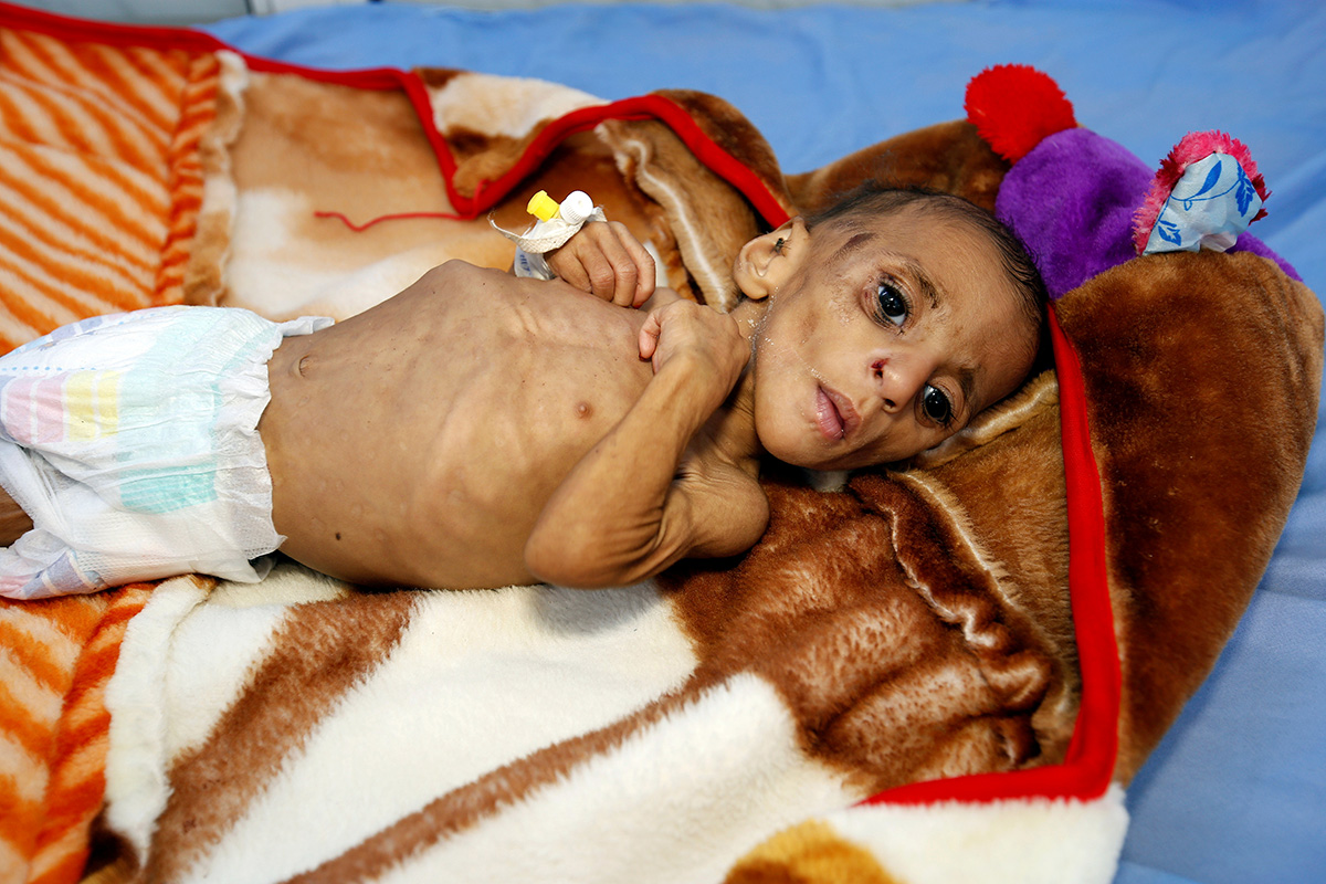 За три года войны спасательные миссии смогли помочь восьми миллионам йеменцев, но многие люди по прежнему нуждаются в гуманитарной помощи. На фото: годовалый Фатима Абдула Хассан в центре помощи жертвам недоедания в Ходейде