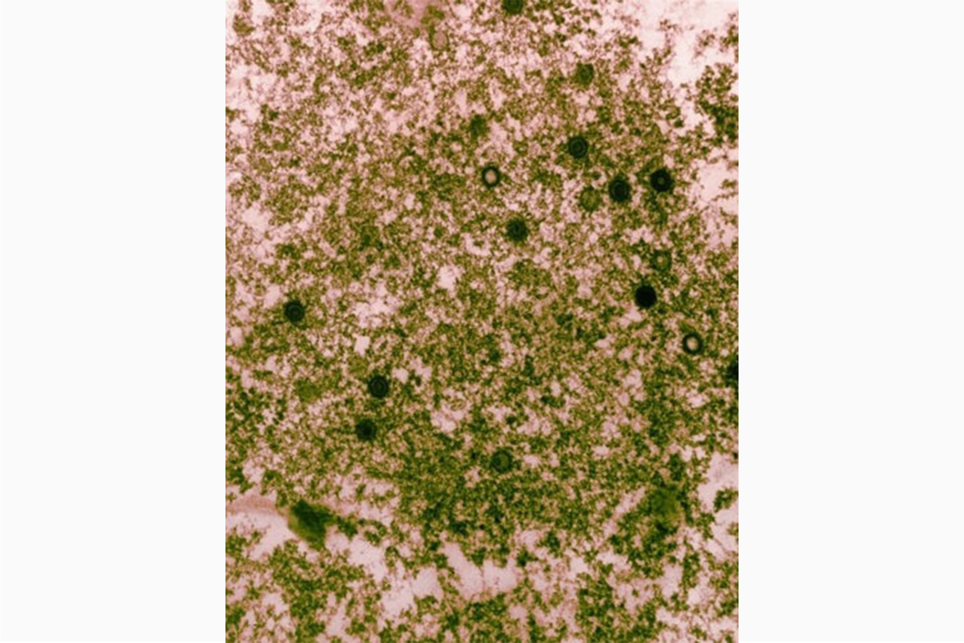 Электронная микрофотография вирусов герпеса человека, таких как вирус Эпштейна-Барр