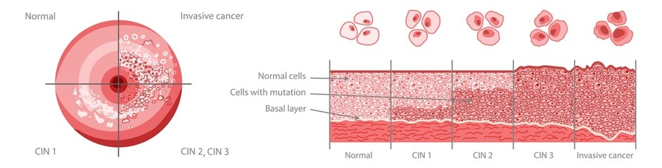 ВПЧ вызывает постепенное перерождение эпителиальных клеток шейки матки. Сначала их немного, затем число может начать расти