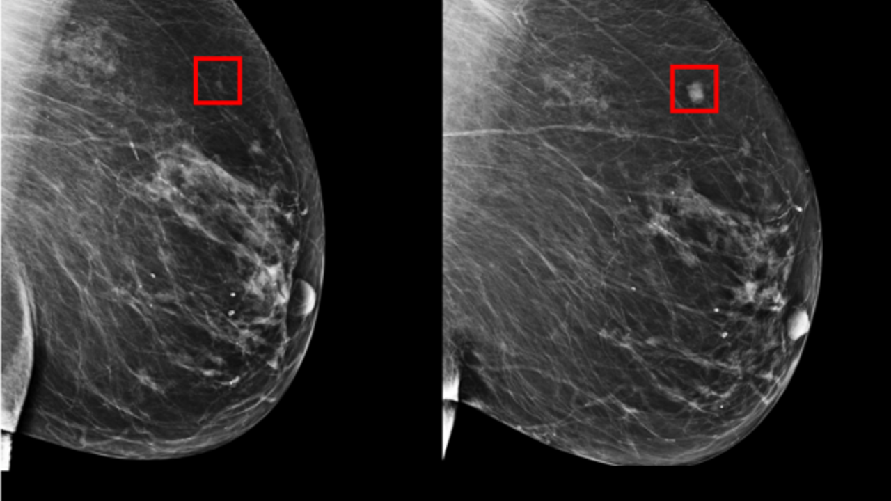 Фото: трехмерное изображение молочной железы, полученное на маммографии. 