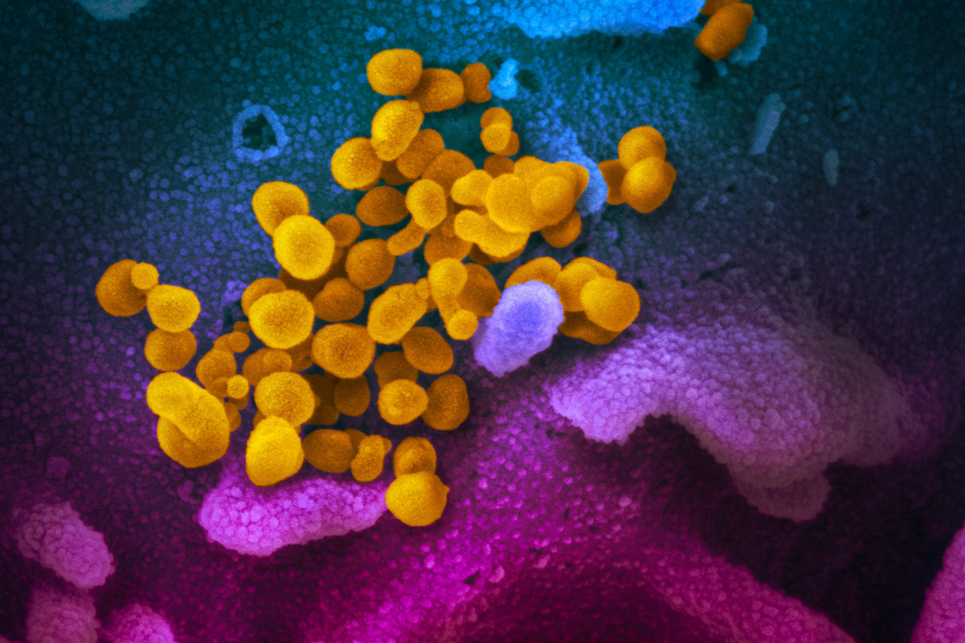 Вирус SARS-CoV-2 при электронно-сканирующей микроскопии, который в 2020 году считался первым вирусом, вызвавшим болезнь X