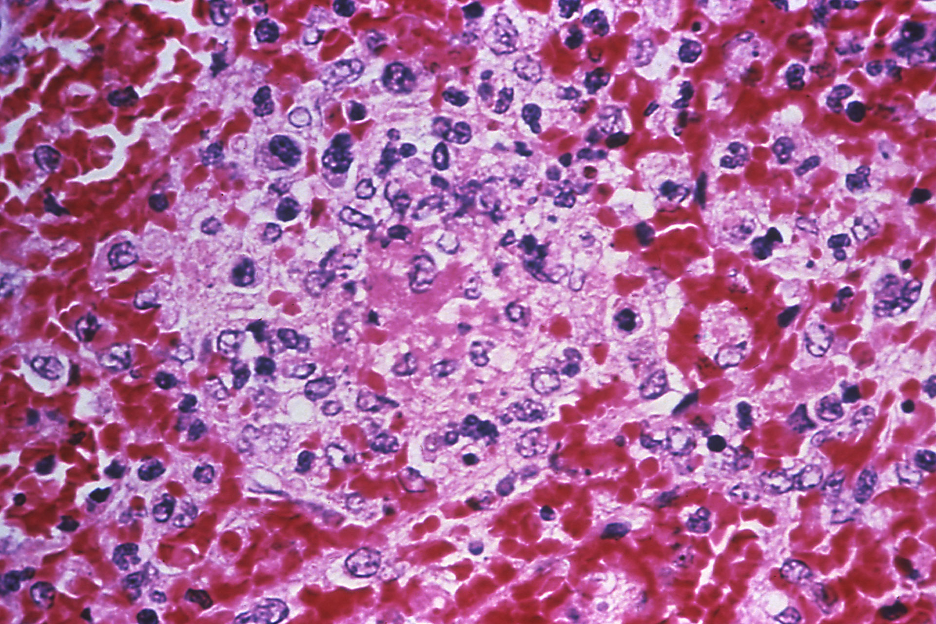 Микрофотография гистопатологических изменений в ткани селезенки в случае заражения чумой человека