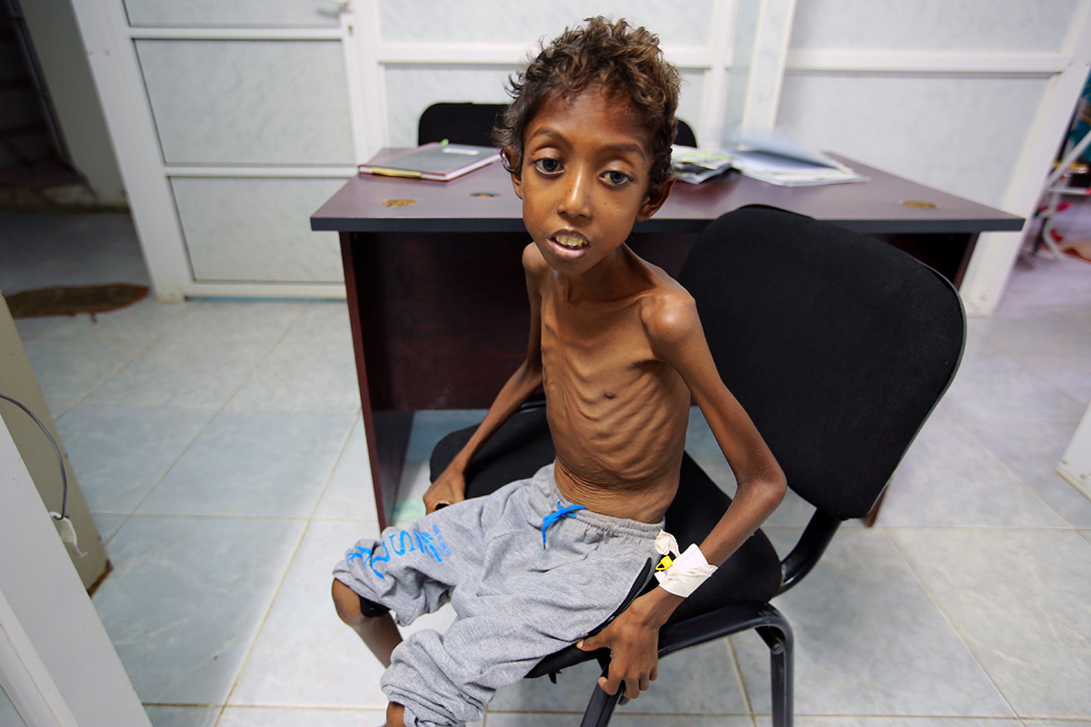 Каждая атака приносит новые разрушения и смерти. За последние двое суток в Йемене погибли как минимум 65 человек, сотни получили ранения. На фото: восьмилетний Имран Фарах в больнице в Ходейде